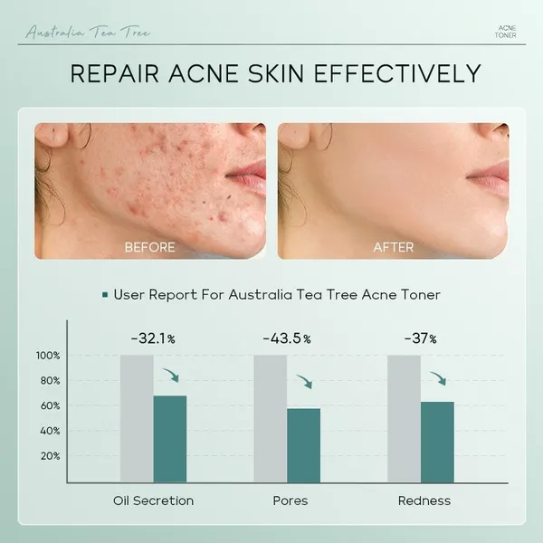 LAIKOU Bye Bye Acne Australia Tea Tree Toner - 100ml