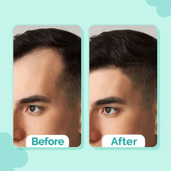 The Derma 20% Actives Peptide-Stem Cell Hair Growth Serum with Foligen Analupe & Anagain For Hair Growth - 30 ml